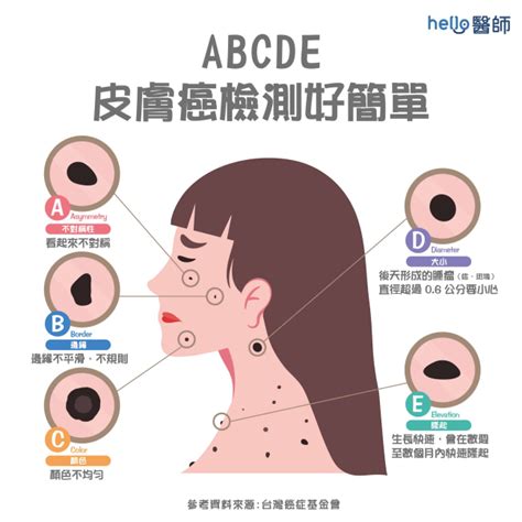 多痣體質|皮膚長痣、長斑是皮膚癌前兆？皮膚癌初期4大症狀快。